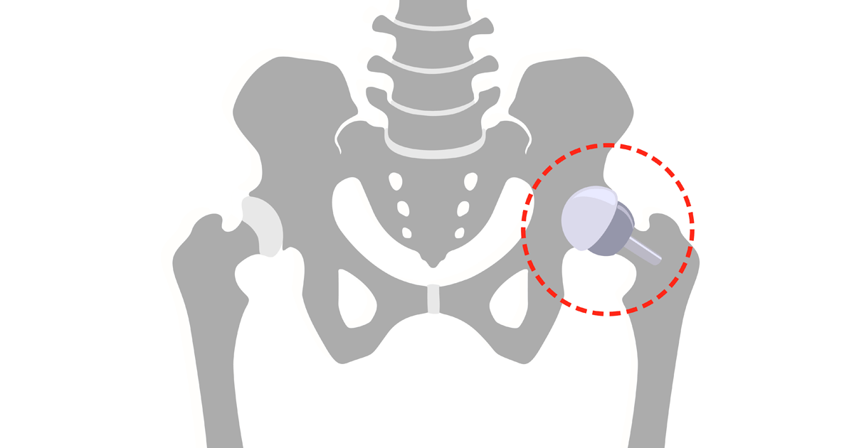 Hip Replacement Surgery